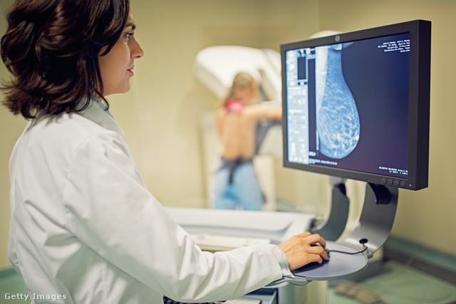 Emlőmirigy MRI felvételét nézi egy orvosnő a számítógépen.
