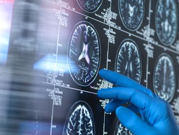 Egy tudós a beteg agyának MRI-felvételét (mágneses rezonancia képalkotás) vizsgálja az öregedés, valamint a demencia és az Alzheimer-kór okozta károsodások felismerése érdekében