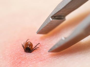 Az orvosi csipesz szorosan megfogja a barna kullancsot, miközben óvatosan eltávolítja az emberi bőrből.